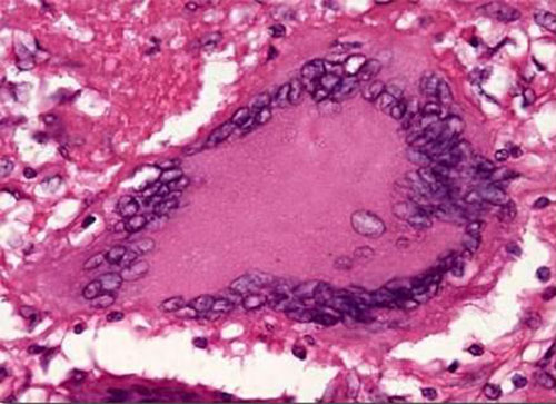 Tuberculinum